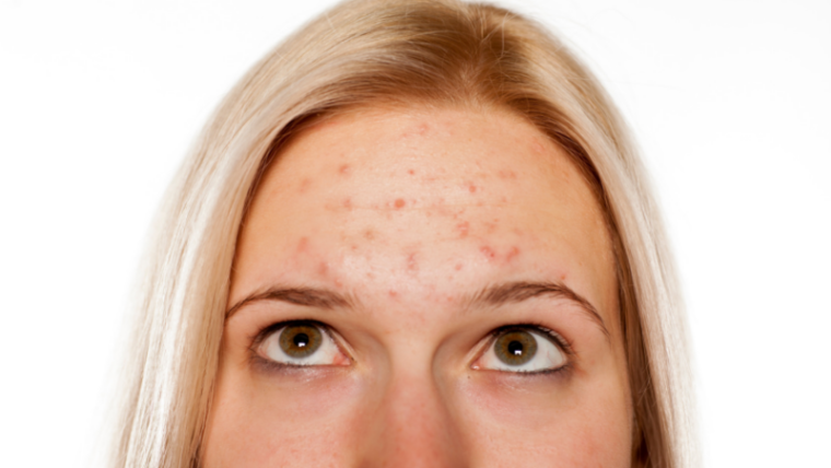 How to Treat Acne without Antibiotics