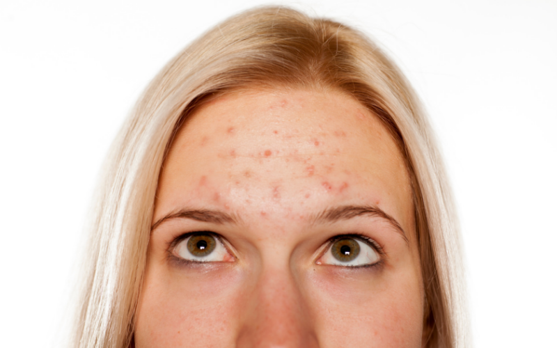 How to Treat Acne without Antibiotics